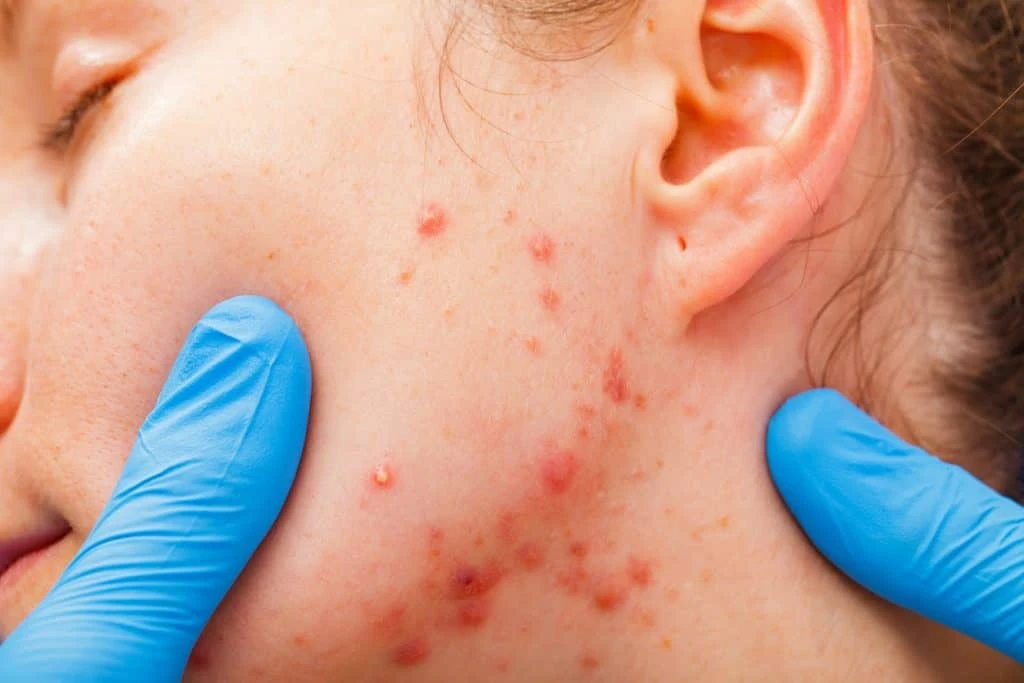 Close-up of a cheek with acne and inflamed spots, examined by a gloved hand from Anchorage Med Spa, highlighting expert skin care.