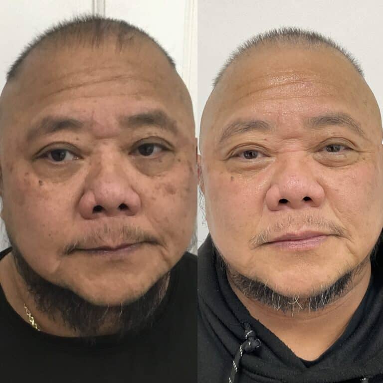 Side-by-side photos of a man; left shows rough skin texture and wrinkles, right shows smoother skin and eye area.