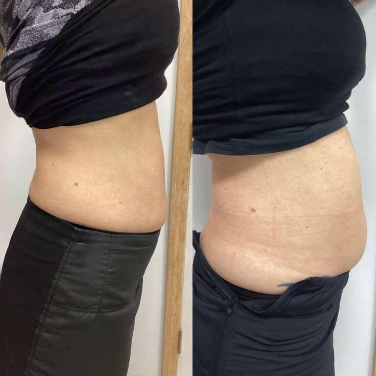 Comparison of abdomen: Left shows smooth silhouette with waist trainer, right displays natural contour without garment.