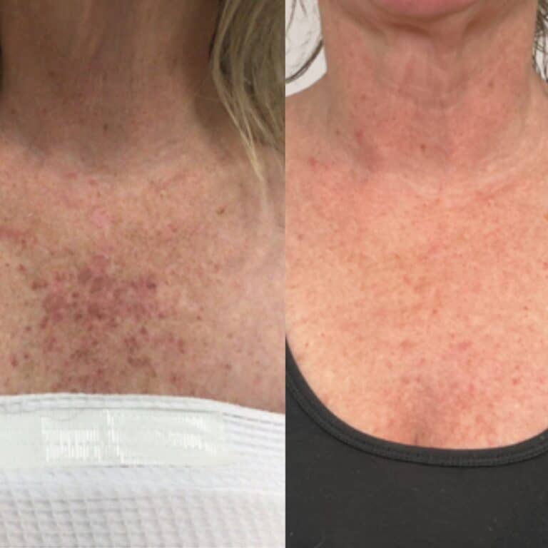 Side-by-side view of a person's chest and neck: red, irritated skin on the left, clearer skin on the right.