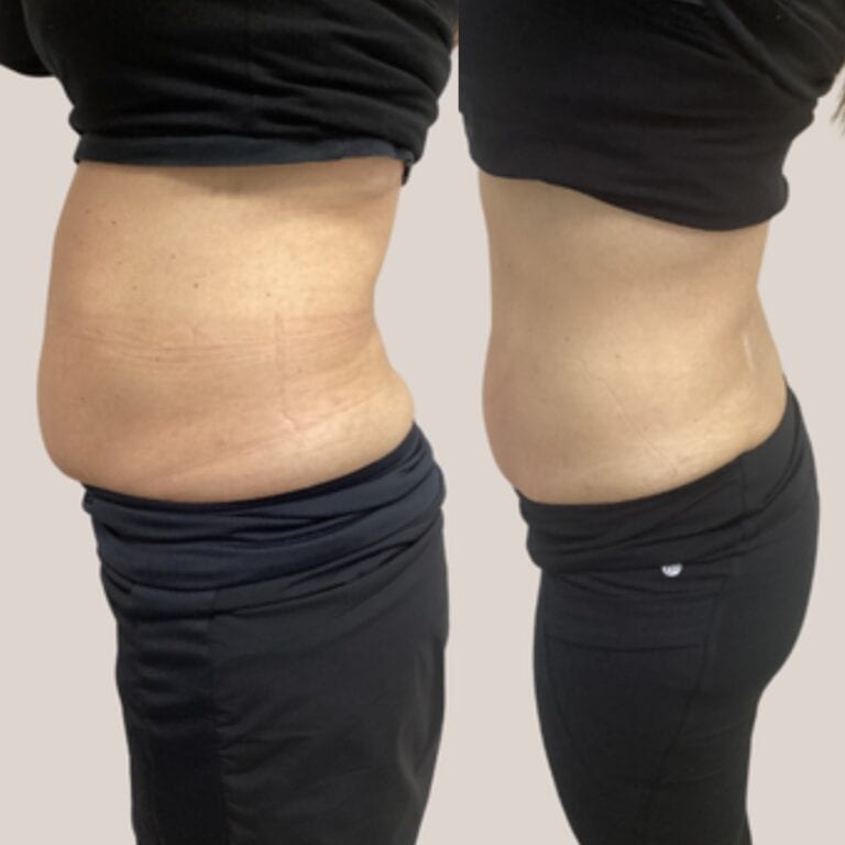 Before-and-after comparison of a person’s midsection in black clothing, showing reduced abdominal size on the right.