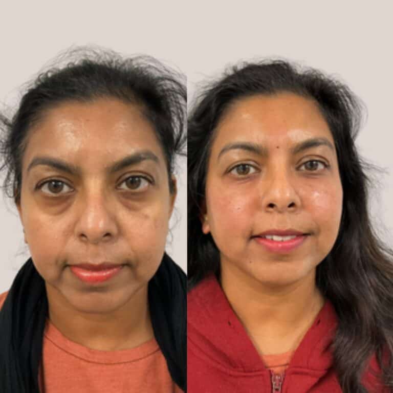 Woman shown before and after cosmetic treatment; after photo features smoother skin and fewer under-eye circles.