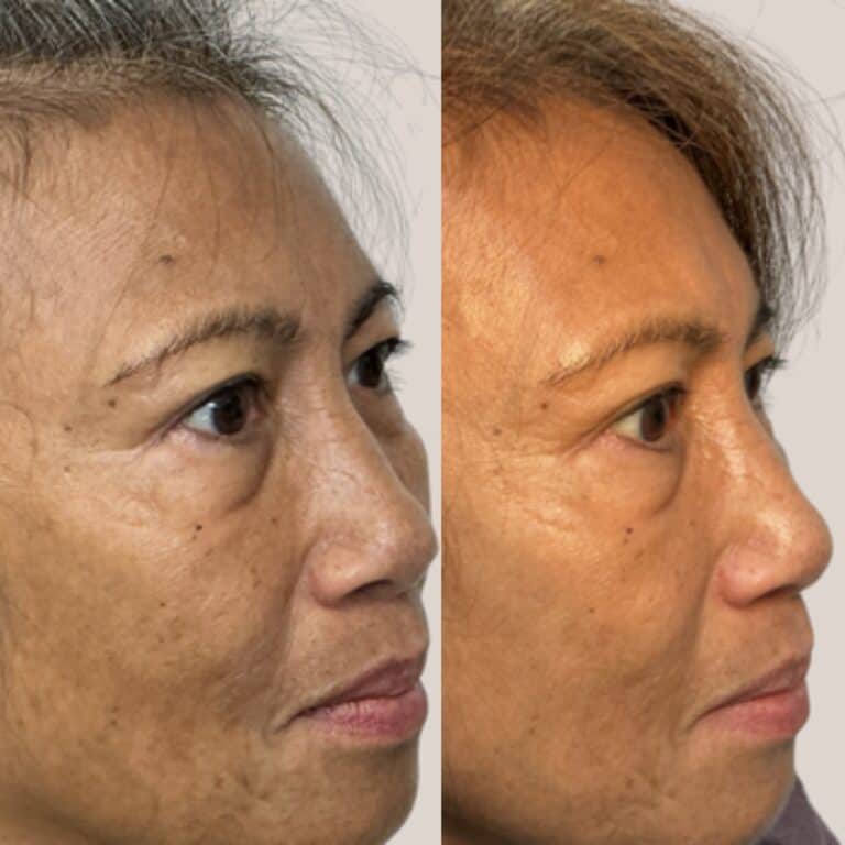 Woman’s face before and after skin treatment, with fewer wrinkles and smoother skin in the after photo.