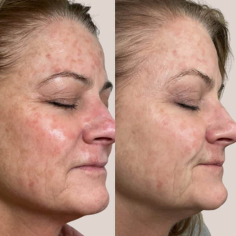 Before and after photos of a woman’s face with eyes closed, showing less redness and fewer spots in the after image.