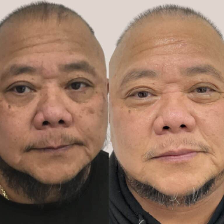 Man’s face shown before and after treatment, with smoother skin and fewer dark spots visible in the right image.
