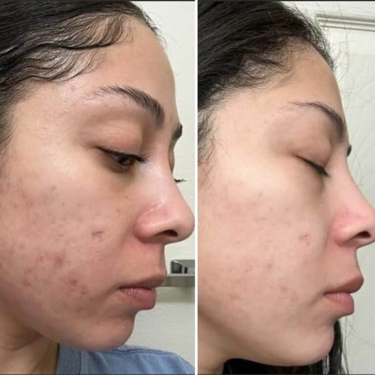 Side-by-side of a woman's face with acne on the left and visibly clearer skin on the right, highlighting skincare results.