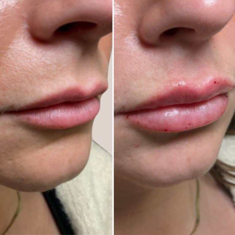 Before-and-after of lips: the right shows fuller lips with small red marks after a cosmetic procedure.
