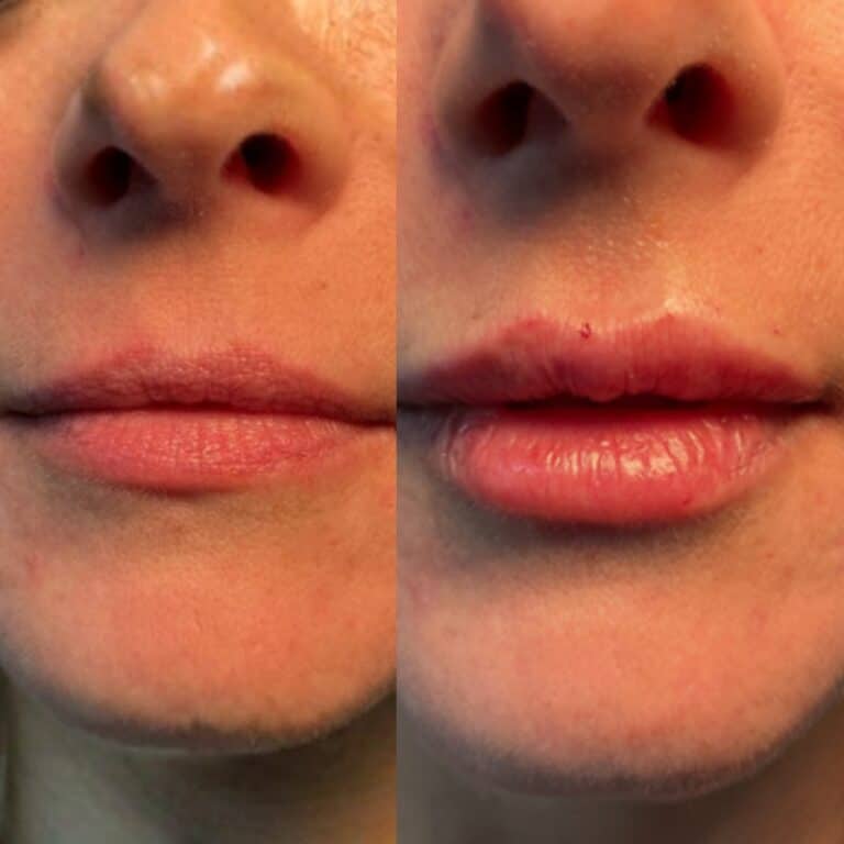 Before-and-after photo comparing lips: left shows natural lips, right shows visibly fuller lips after enhancement procedure.