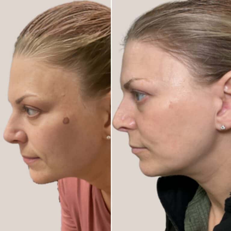 Side-by-side photos of a woman’s profile, left with a large mole on her cheek, right after the mole has been removed.