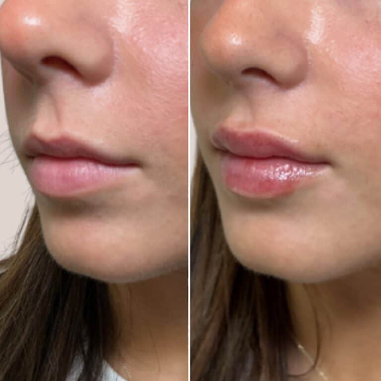 Before and after photos of a woman's lips; the after image shows noticeably fuller, shinier lips following enhancement.