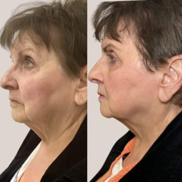 Before-and-after profile photos of an older woman showing firmer skin and less sagging on her jawline and neck after a procedure.