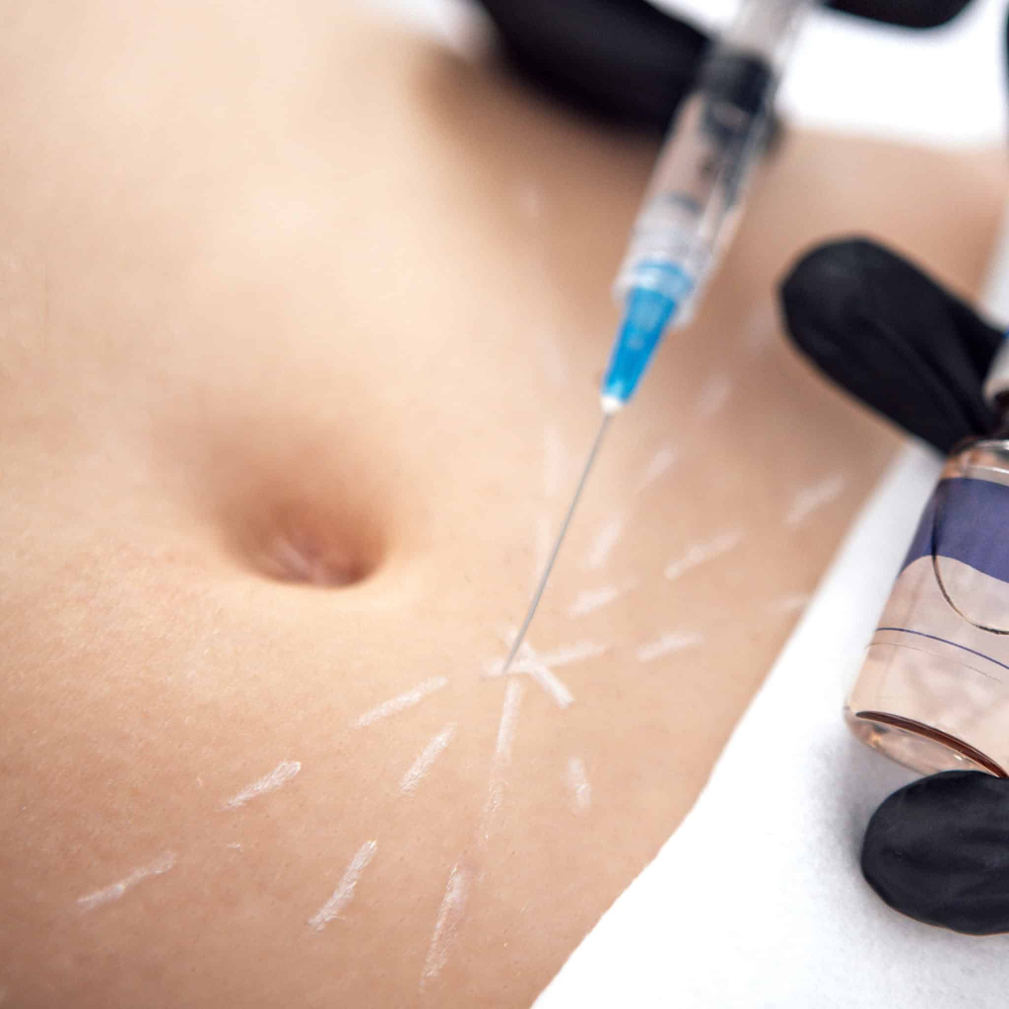 Gloved hand injecting syringe into marked skin near abdomen, showing Alaska skin rejuvenation at Anchorage medical spa.