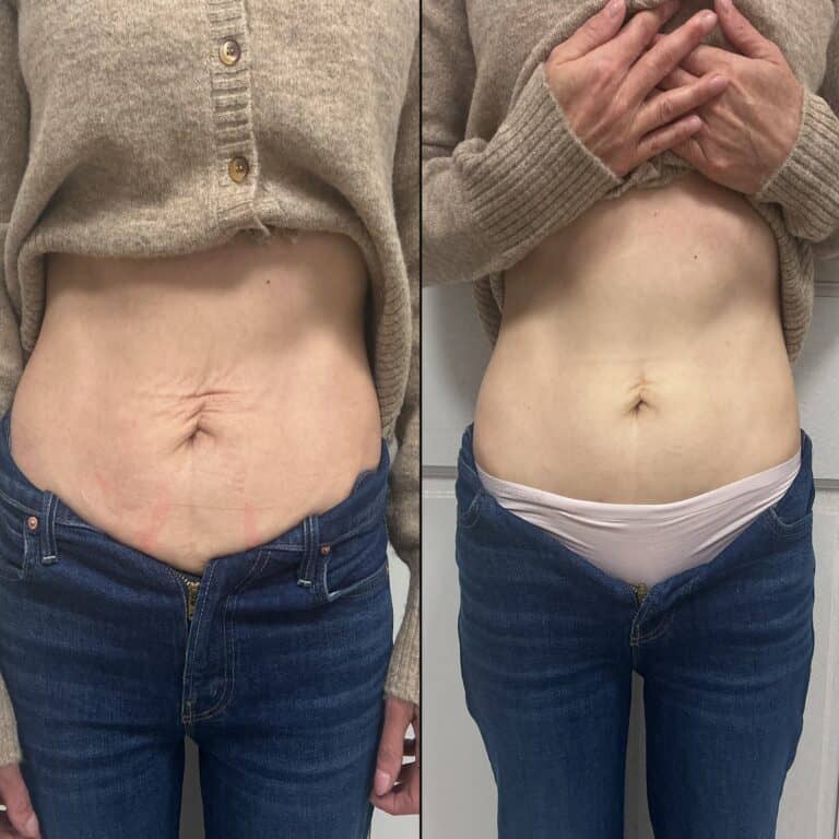 Before and after photos of a person’s midsection in jeans, highlighting changes in skin texture and shape.