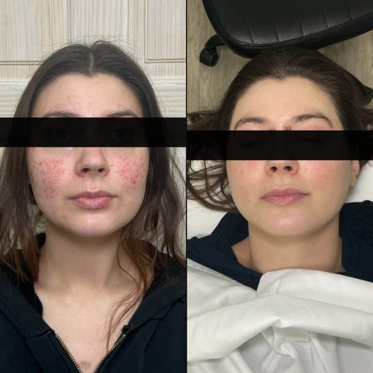 Woman’s face before and after treatment, showing less redness and smoother skin in the after photo.