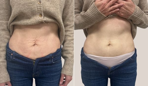 Before and after photo showing changes in a person’s midsection following a cosmetic procedure.